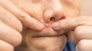 Jerawat di Kumis Pria