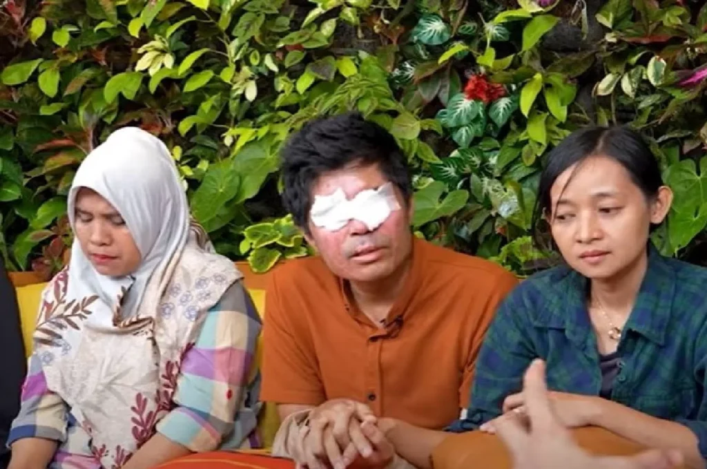 Agus Korban Penyiraman Air Keras